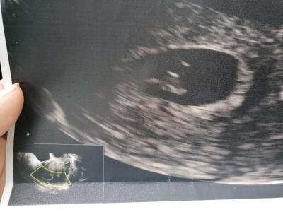 Neplodnost | IVF ve věku 38+, podstupujete ho teď někdo?