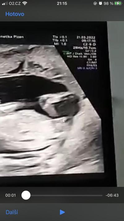 Těhotenství | Pohlaví podle ultrazvuku 12+4tt