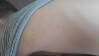 Alergie a ekzémy | Vyrážka u 8leté dcery poraďte