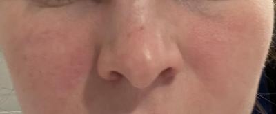Zdravotní potíže dospělých | Lupus? je tu lekar?