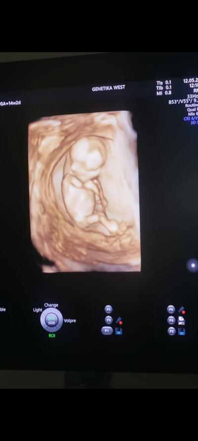 Těhotenství | Miminko pohlaví ultrazvuk poradte