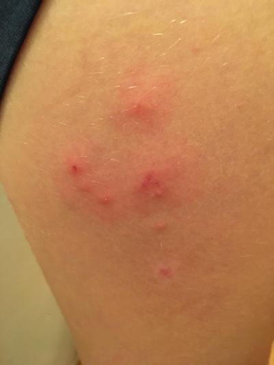 Alergie a ekzémy | Vyrážka/pupínky, co je to?