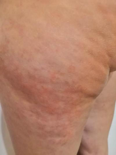 Alergie a ekzémy | Vyrážka na stehně u 4 letého