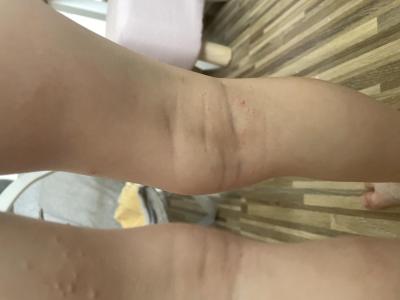 Alergie a ekzémy | Divné pupínky na nožičkách