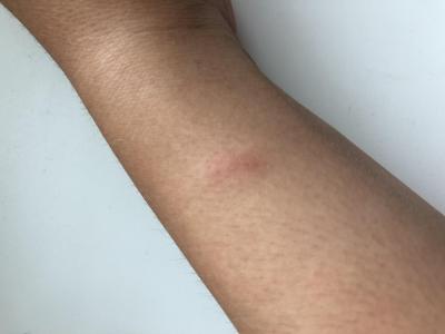 Alergie a ekzémy | Nesvědivé pupínky a flíčky