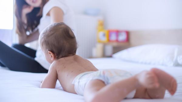 Spalničky u dětí. Jaké zkušenosti mají maminky z eMimina?