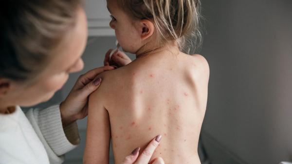 Molusky u dětí - jaké jsou zkušenosti uživatelek eMimina?