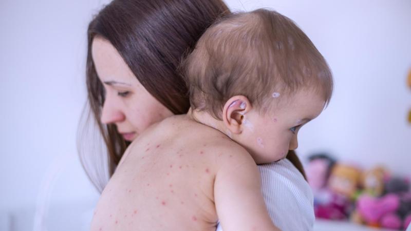 Maminka drží v náručí miminko s neštovicemi.