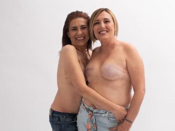 Mastektomie: Co to je a jak probíhá?