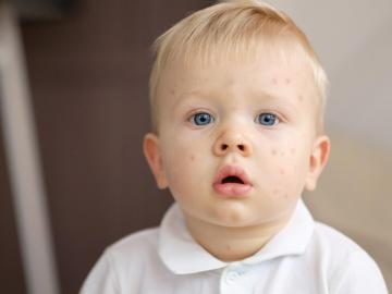 Petechie: Jak je poznat a co znamenají?