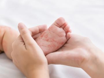 Sedmá nemoc: Jaké jsou příznaky a jak ji léčit?