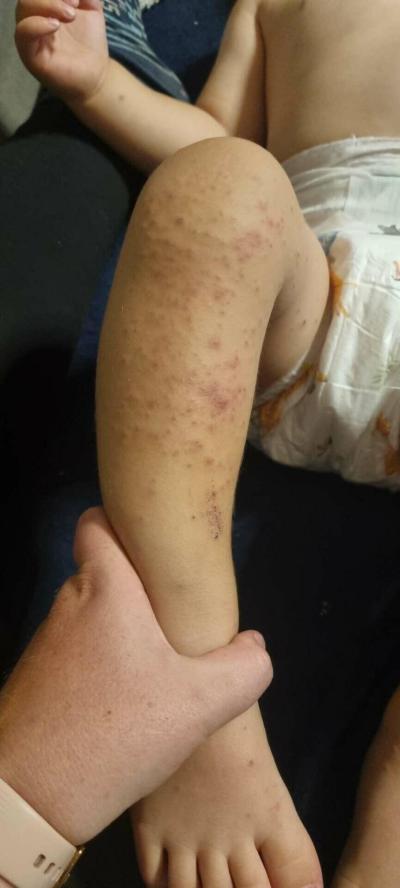 Alergie a ekzémy | Alergie nebo detska nemoc