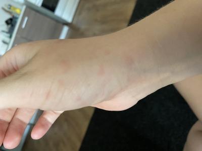 Alergie a ekzémy | Fleky na ruce reakce?
