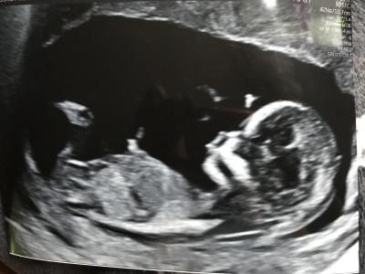 Těhotenství | Pohlaví mimi podle ultrazvuku?