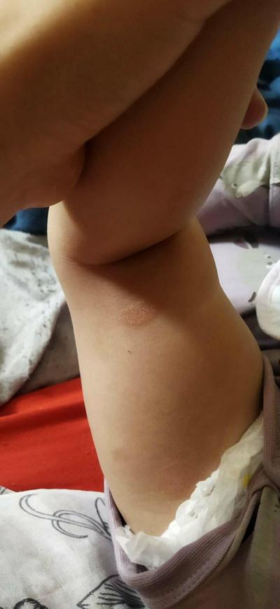 Dětské nemoci | Vyrážka u půlročního dítěte