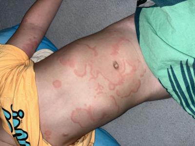 Předškoláček (3 až 6 let) | Ohraničené fleky po celém těle