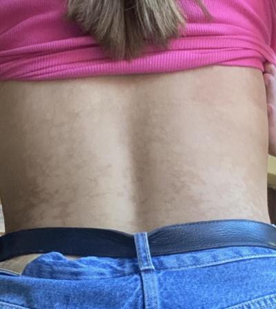 Zdravotní potíže dospělých | Fleky na těle u dospělého