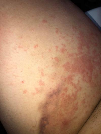 Alergie a ekzémy | Vyrážka / ekzém / alergie