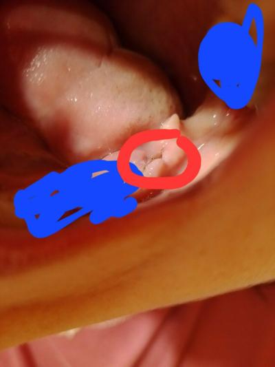 Zdravotní potíže dospělých | Suché lůžko po extrakci osmičky + foto