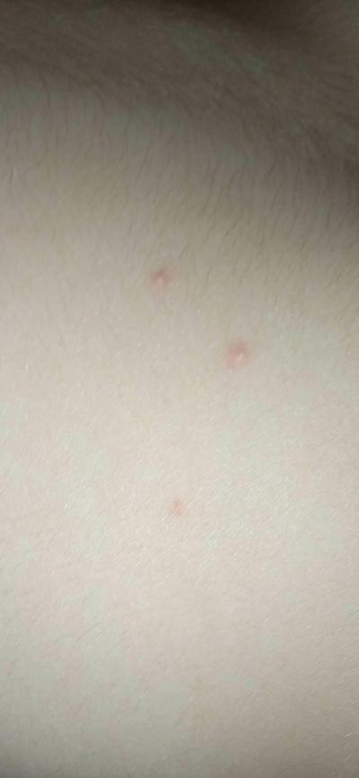 Dětské nemoci | Zarudlé pupínky