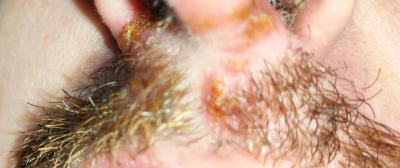 Zdravotní potíže dospělých | Jedná se o impetigo?