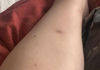 Zdravotní potíže dospělých | Co je to, modřina?