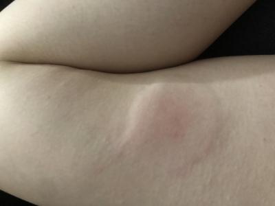 Zdravotní potíže dospělých | Nateklé bolestivé stehno a klíště