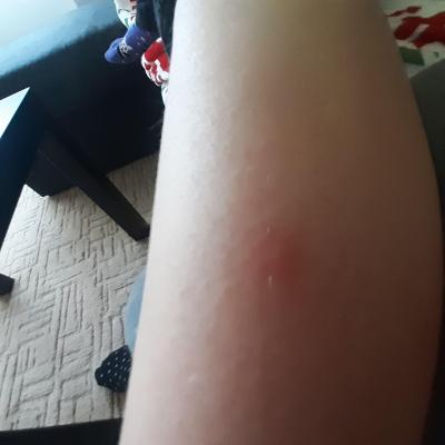 Dětské nemoci | Nateklé pupínky