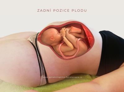Porod a šestinedělí | Zadní pozice plodu