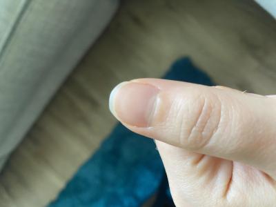 Zdravotní potíže dospělých | Infekce pod nehtem?