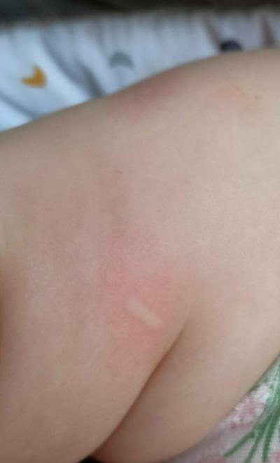 Alergie a ekzémy | Mizející vyrážka u miminka
