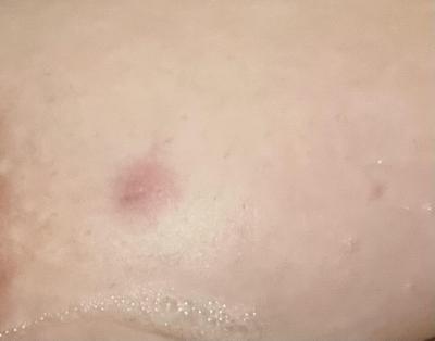 Zdravotní potíže dospělých | Červená boulička na prsu