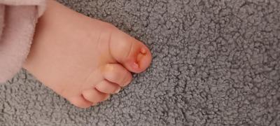 Batole (12 až 36 měsíců) | Zarůstání nehtů u dítěte