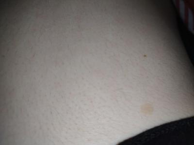 Zdravotní potíže dospělých | Nahnědlé flíčky na těle