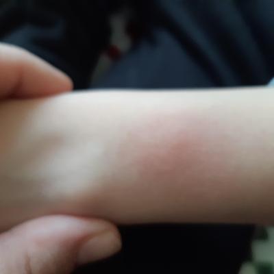 Dětské nemoci | Nateklé pupínky