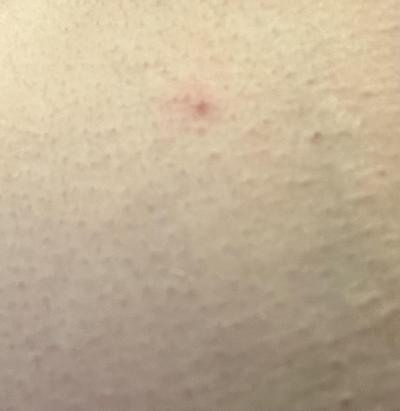 Alergie a ekzémy | Je toto svrab