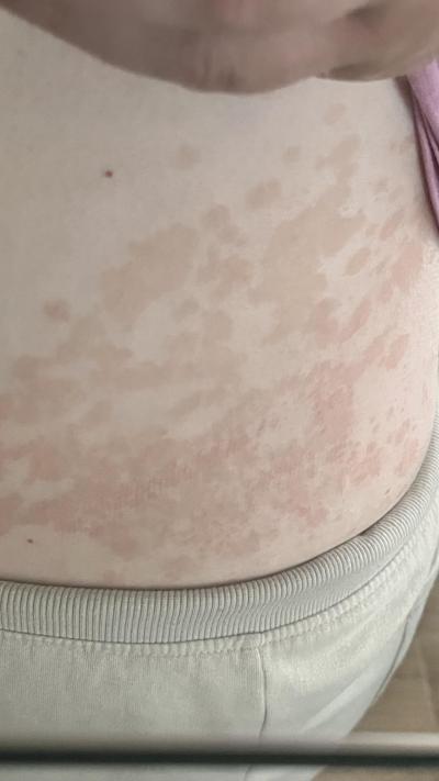 Zdravotní potíže dospělých | Ví někdo, co je to za fleky?