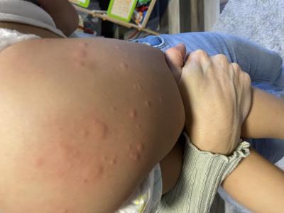 Alergie a ekzémy | Vyrážka - dítě 2,5 roku