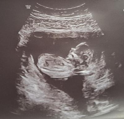 Těhotenství | TP září 2023