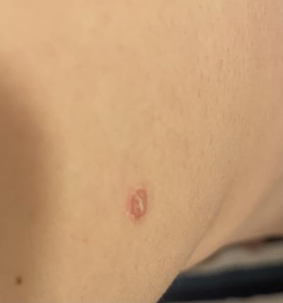 Alergie a ekzémy | Červený suchý menší flek