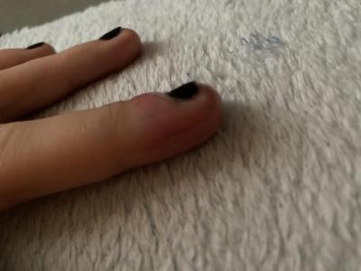 Vše možné | Natekly prst