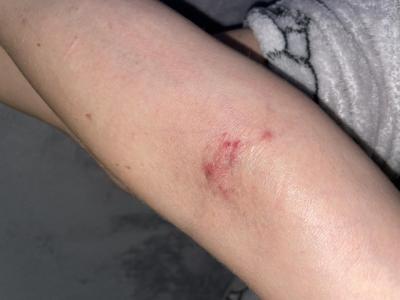 Alergie a ekzémy | Vyrážka na přední straně předloktí.