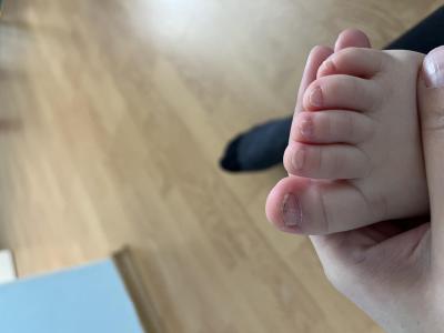 Dětské nemoci | Nehtiky u skoro 2lete dcery…rada?