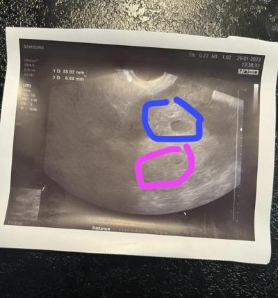 Centra asistované reprodukce | Sanus - IVF - jak probíhá?