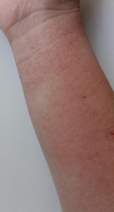 Alergie a ekzémy | Svědivá vyrážka už 5 dní