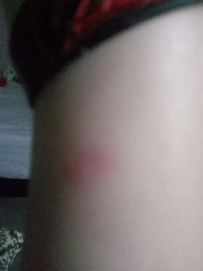 Alergie a ekzémy | Jedná se o svrab?