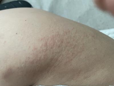 Zdravotní potíže dospělých | Vyrážka na bocích