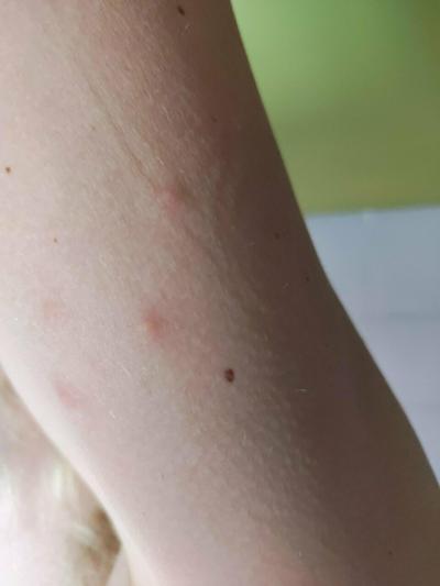 Alergie a ekzémy | Jedná se o svrab?