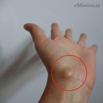 Dětské nemoci | Tvrdá boulička na ruce dcery
