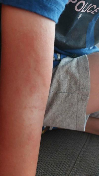 Alergie a ekzémy | Koprivka 4 lete dite